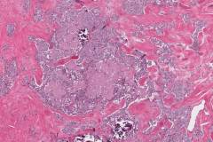 Medullary thyroid carcinoma