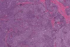 Medullary thyroid carcinoma