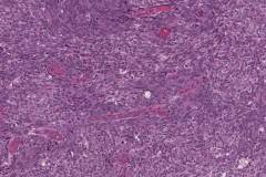 Medullary thyroid carcinoma