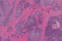 Medullary thyroid carcinoma