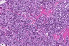 Medullary thyroid carcinoma