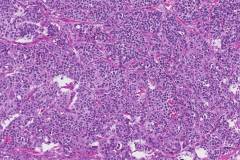 Medullary thyroid carcinoma