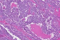 Medullary thyroid carcinoma