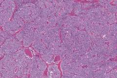 Medullary thyroid carcinoma