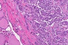 Medullary thyroid carcinoma
