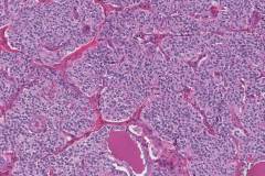 Medullary thyroid carcinoma