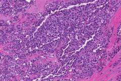 Medullary thyroid carcinoma