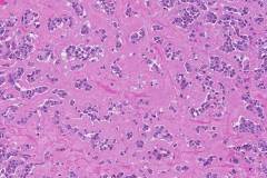 Medullary thyroid carcinoma
