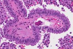 Medullary thyroid carcinoma