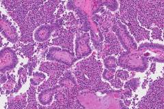 Medullary thyroid carcinoma