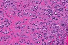Medullary thyroid carcinoma