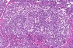 Medullary thyroid carcinoma