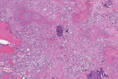 Metastatic medullary thyroid carcinoma and papillary thyroid carcinoma to a lymph node