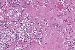 Metastatic medullary thyroid carcinoma and papillary thyroid carcinoma to a lymph node