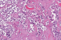 Metastatic medullary thyroid carcinoma to a lymph node