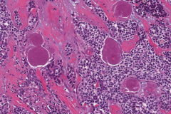 Metastatic medullary thyroid carcinoma to a lymph node