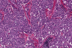 Metastatic medullary thyroid carcinoma to a lymph node