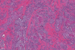 Metastatic medullary thyroid carcinoma to a lymph node
