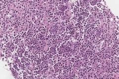Metastatic high grade medullary thyroid carcinoma to a lymph node