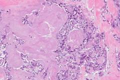 Medullary thyroid carcinoma