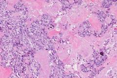Medullary thyroid carcinoma