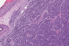 Merkle cell carcinoma