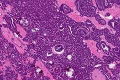 Metanephric adenoma of the kidney