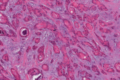 Microcystic adnexal carcinoma