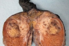 Mixed germ cell tumour predominantly embryonal carcinoma