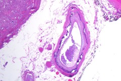 Monckeberg's arteriosclerosis