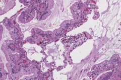 Mucinous adenocarcinoma of the lung