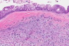 Mucinous cystic neoplasm of the pancreas