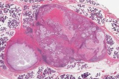 Mucoepidermoid carcinoma