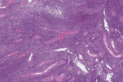 Mucosal melanoma of the nasal cavity