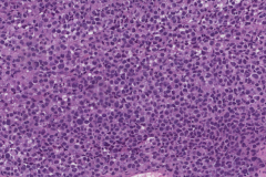 Mucosal melanoma of the nasal cavity