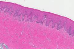 Mucosal melanoma in situ of the hard palate