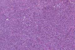 Mucosal melanoma of the hard palate