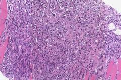 Myeloid sarcoma