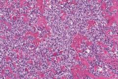 Myoepithelial carcinoma