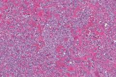 Myoepithelial carcinoma