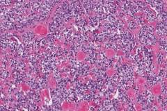 Myoepithelial carcinoma