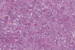 Myoepithelial carcinoma of the parotid gland