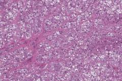 Myoepithelial carcinoma of the parotid gland