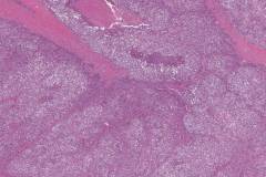 Myoepithelial carcinoma of the parotid gland