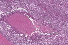 Myoepithelial carcinoma of the parotid gland