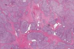 Myoepithelial carcinoma of the parotid gland