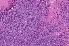 Myoepithelial carcinoma of the palate