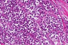 Myoepithelial carcinoma of the parotid gland