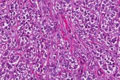 Myoepithelial carcinoma of the parotid gland