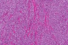 Myoepithelial carcinoma of the parotid gland